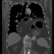 Hiatal hernia, upside-down stomach: CT - Computed tomography